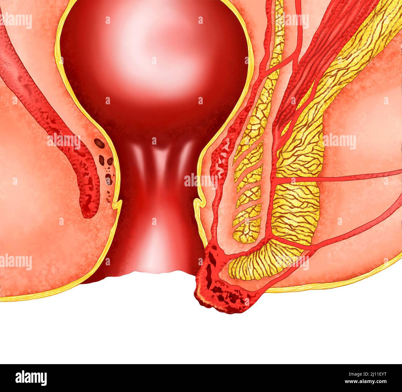 illustrazione realistica dell'anatomia delle emorroidi Foto Stock