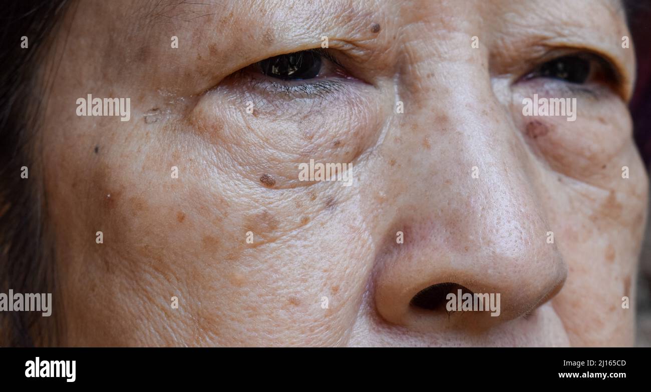 Piccole macchie marroni chiamate macchie di età sul volto della donna anziana asiatica. Sono anche chiamati macchie di fegato, lentigo senile, o macchie di sole. Primo piano. Foto Stock