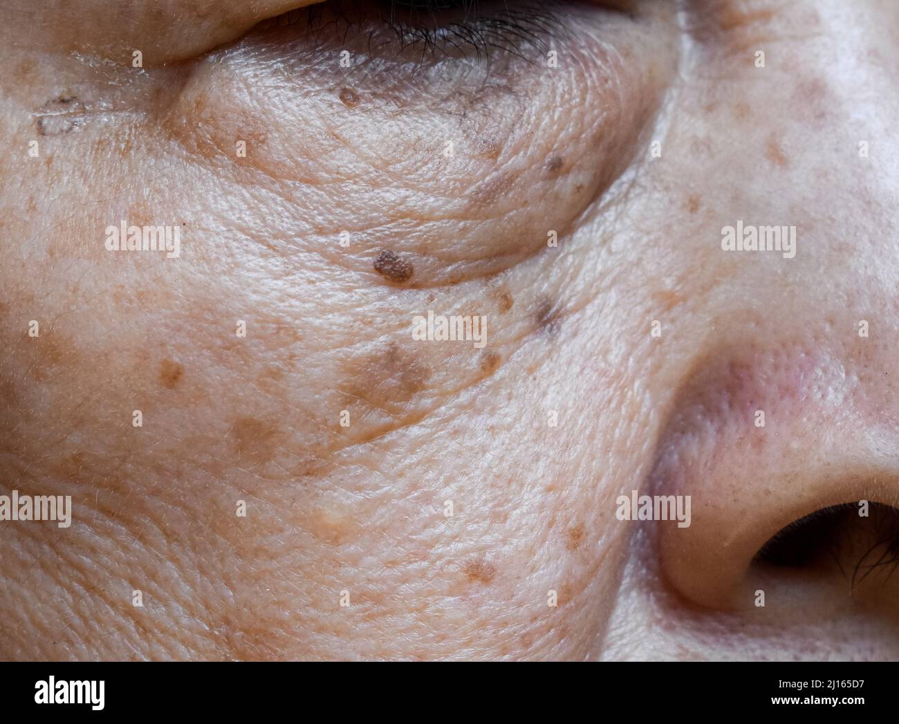 Piccole macchie marroni chiamate macchie di età sul volto della donna anziana asiatica. Sono anche chiamati macchie di fegato, lentigo senile, o macchie di sole. Primo piano. Foto Stock