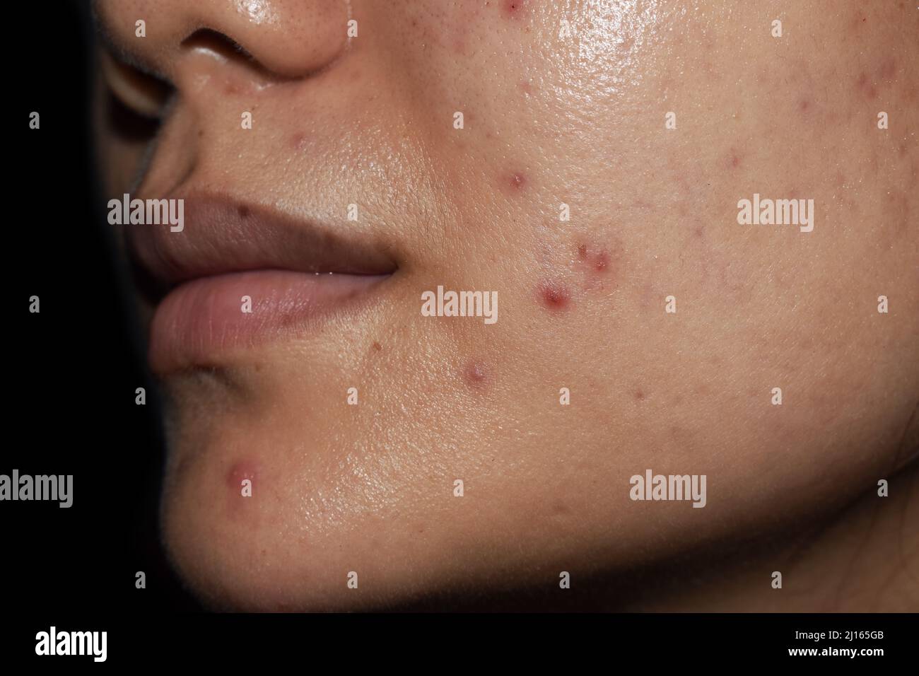 Acne, macchie rosse e cicatrici sul volto della giovane donna asiatica Foto  stock - Alamy