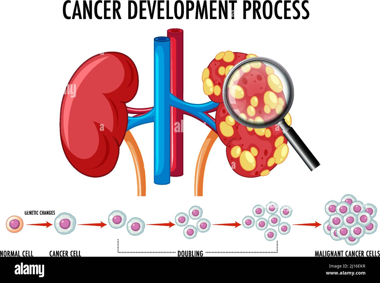 Diagramma che mostra l'illustrazione del processo di sviluppo del cancro Illustrazione Vettoriale