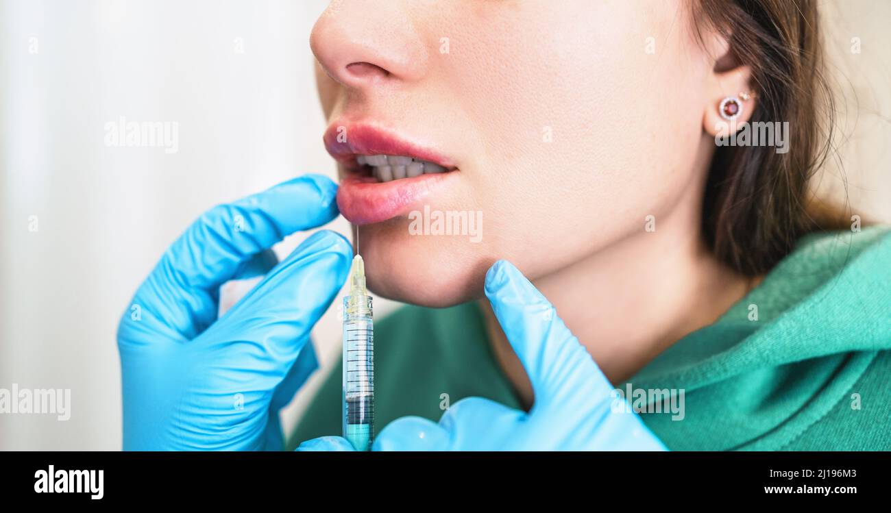 Iniezione delle labbra. Ringiovanimento facciale con riempitivo ialuronico cosmetico. Procedura di aumento e correzione delle labbra. Foto Stock