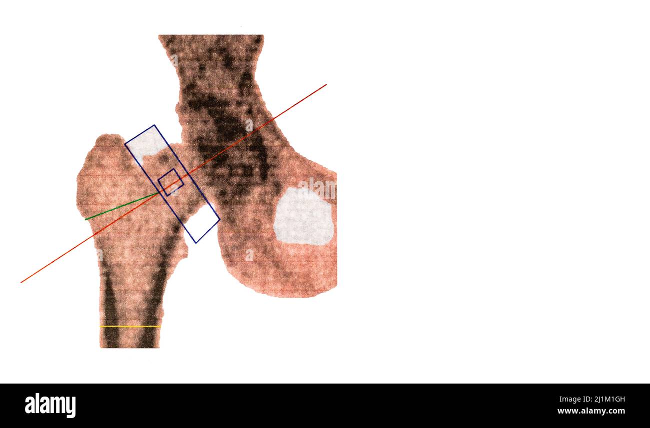 Foto ravvicinata del test di osteodensimetria femorale destro DEXA, che misura la densità ossea mediante raggi X, utilizzato per diagnosticare l'osteoporosi Foto Stock