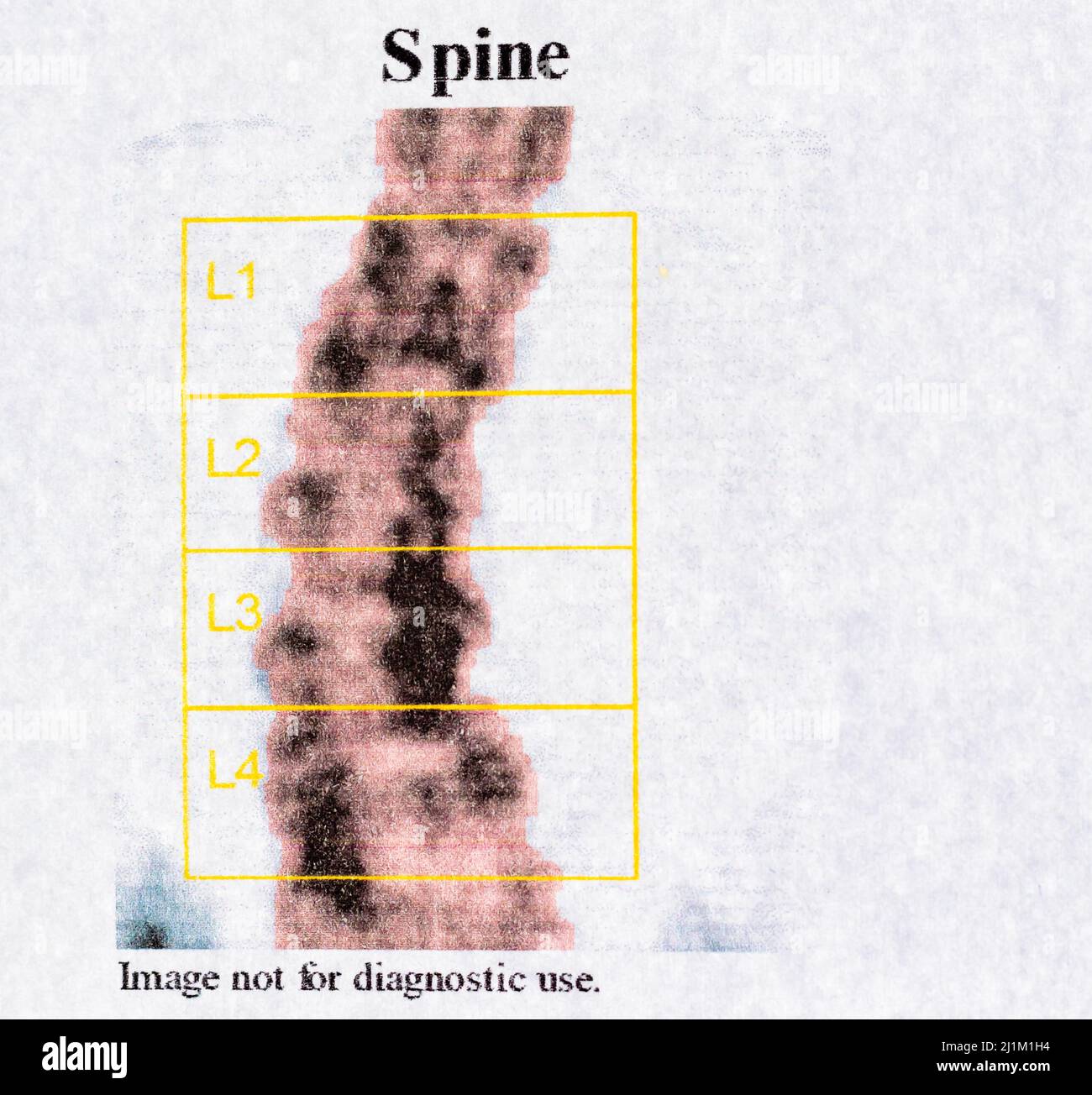 Foto da vicino del test DEXA - osteodensimetria della colonna vertebrale, che misura la densità ossea mediante raggi X, utilizzata per diagnosticare l'osteoporosi Foto Stock