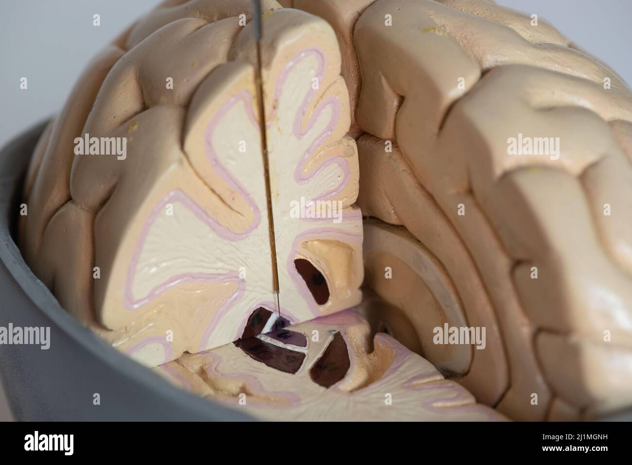 Vista ravvicinata della registrazione microelettrodo di globus pallidus per la chirurgia del morbo di Parkinson Foto Stock