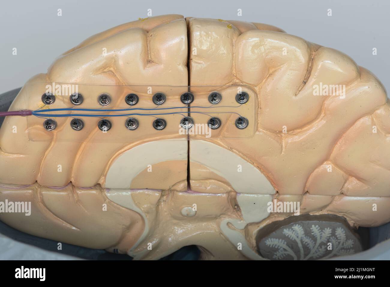 Vista ravvicinata dell'elettrodo subdurale per la registrazione di onde cerebrali o elettroencefalografia sulla superficie mediale dell'emisfero cerebrale. Foto Stock