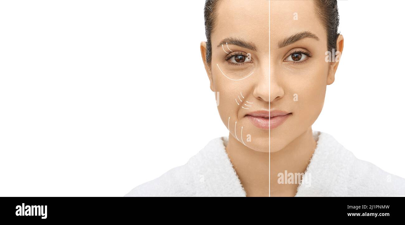 Il viso della donna prima e dopo il serraggio della pelle e le procedure anti-invecchiamento. Rimozione di rughe, pieghe nasolabiali, procedura di ringiovanimento della pelle Foto Stock