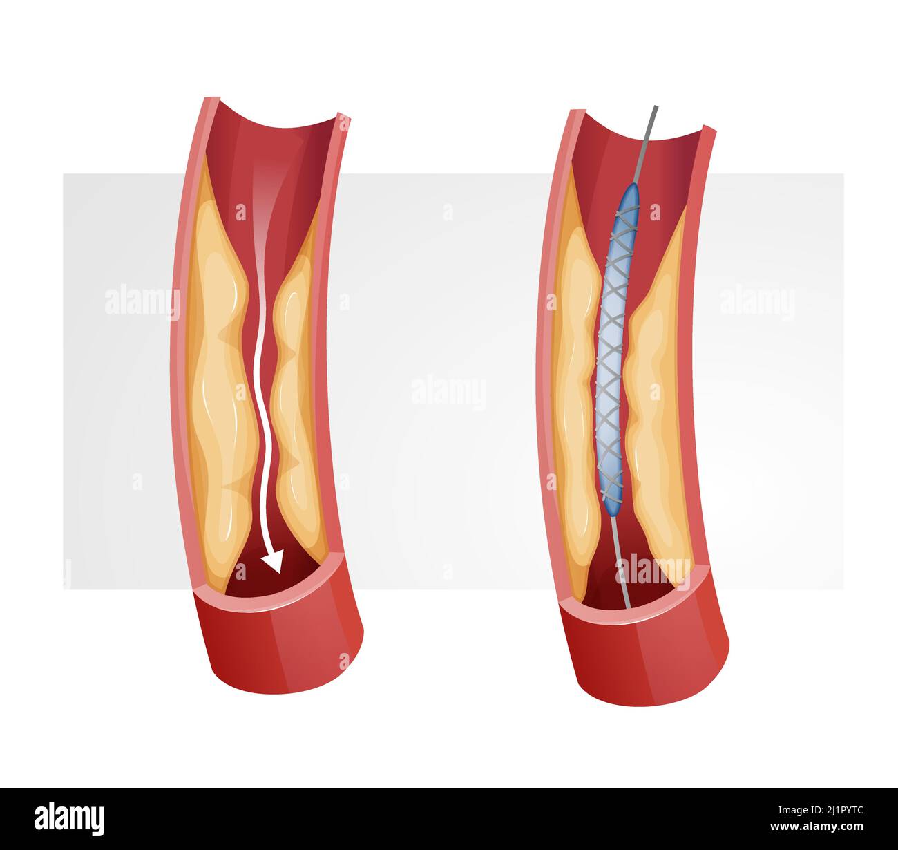 Procedura per stent cardiaco - Illustrazione in stock come file EPS 10 Illustrazione Vettoriale