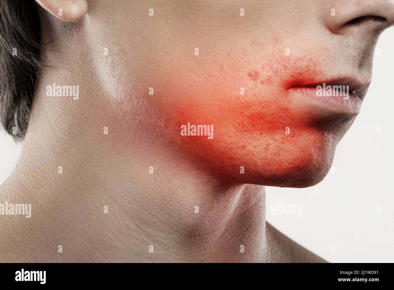 Irritazioni cutanee sensibili dopo una routine di rasatura Foto Stock