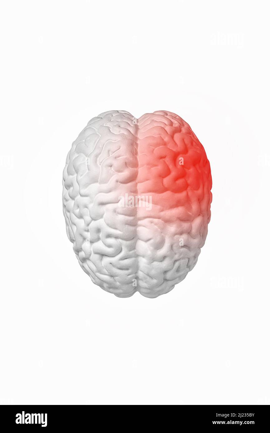 Il concetto di ictus, mal di testa, vista dall'alto del cervello umano isolato su sfondo bianco. Neurochirurgia e assistenza medica per problemi cerebrali Foto Stock