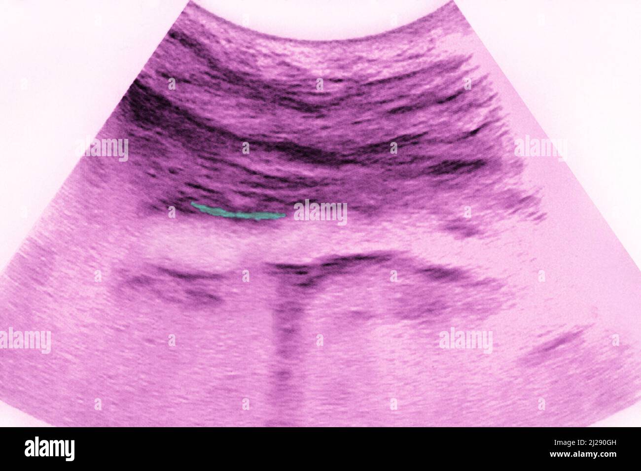 Ateroma aortico Foto Stock