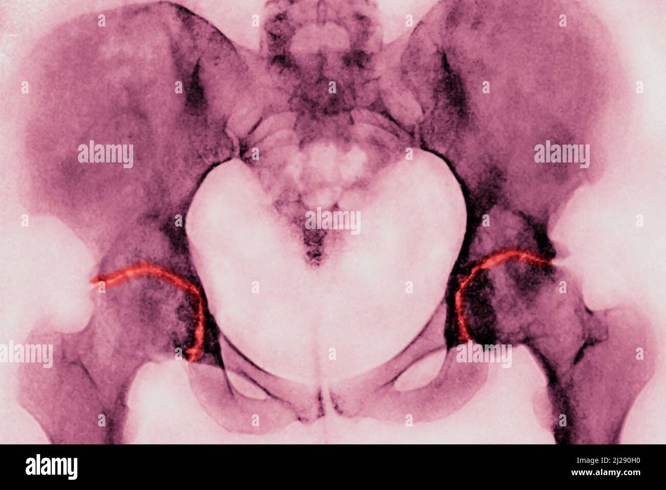 Osteoartrite delle anche Foto Stock