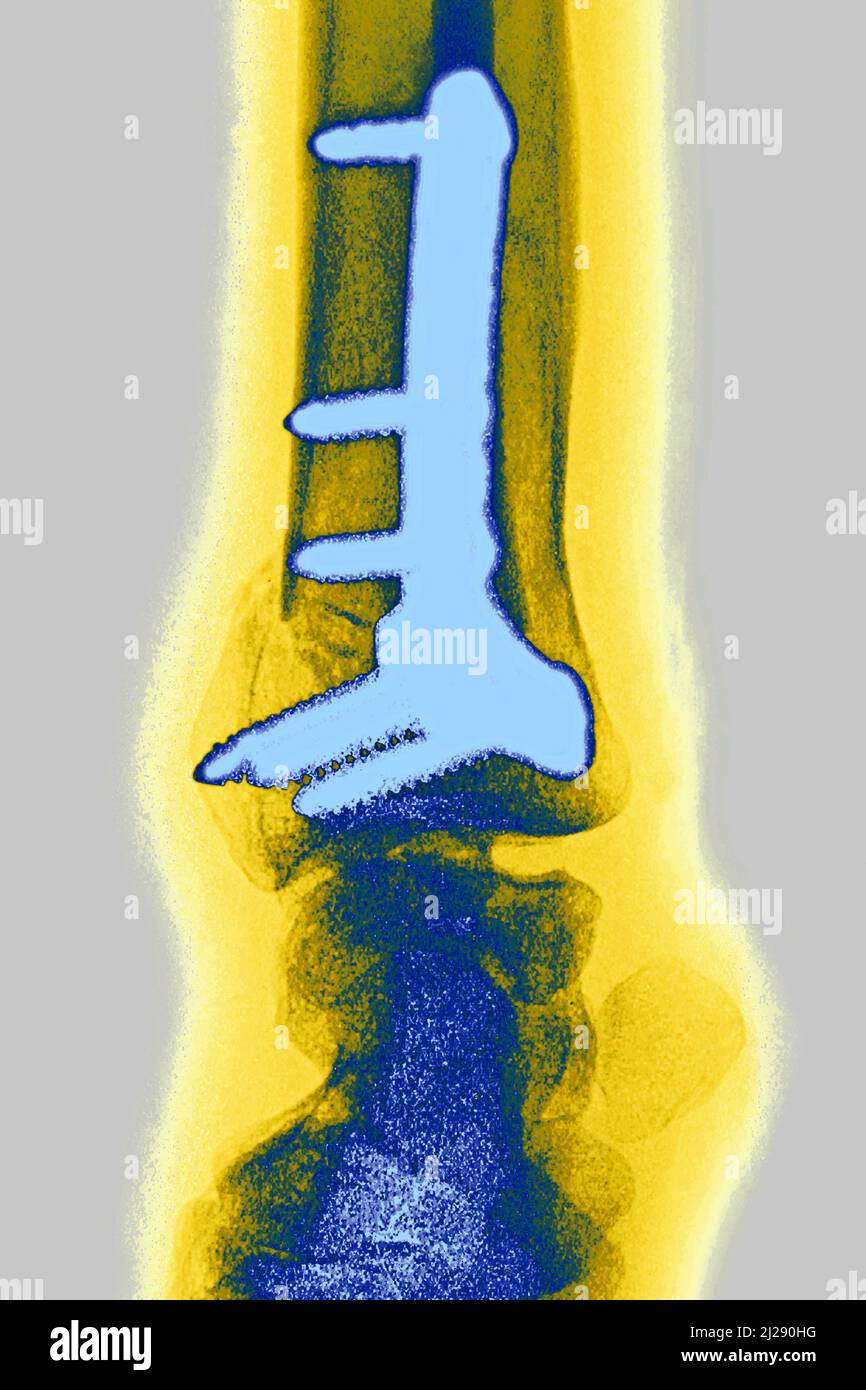 Osteocitesi del polso Foto Stock