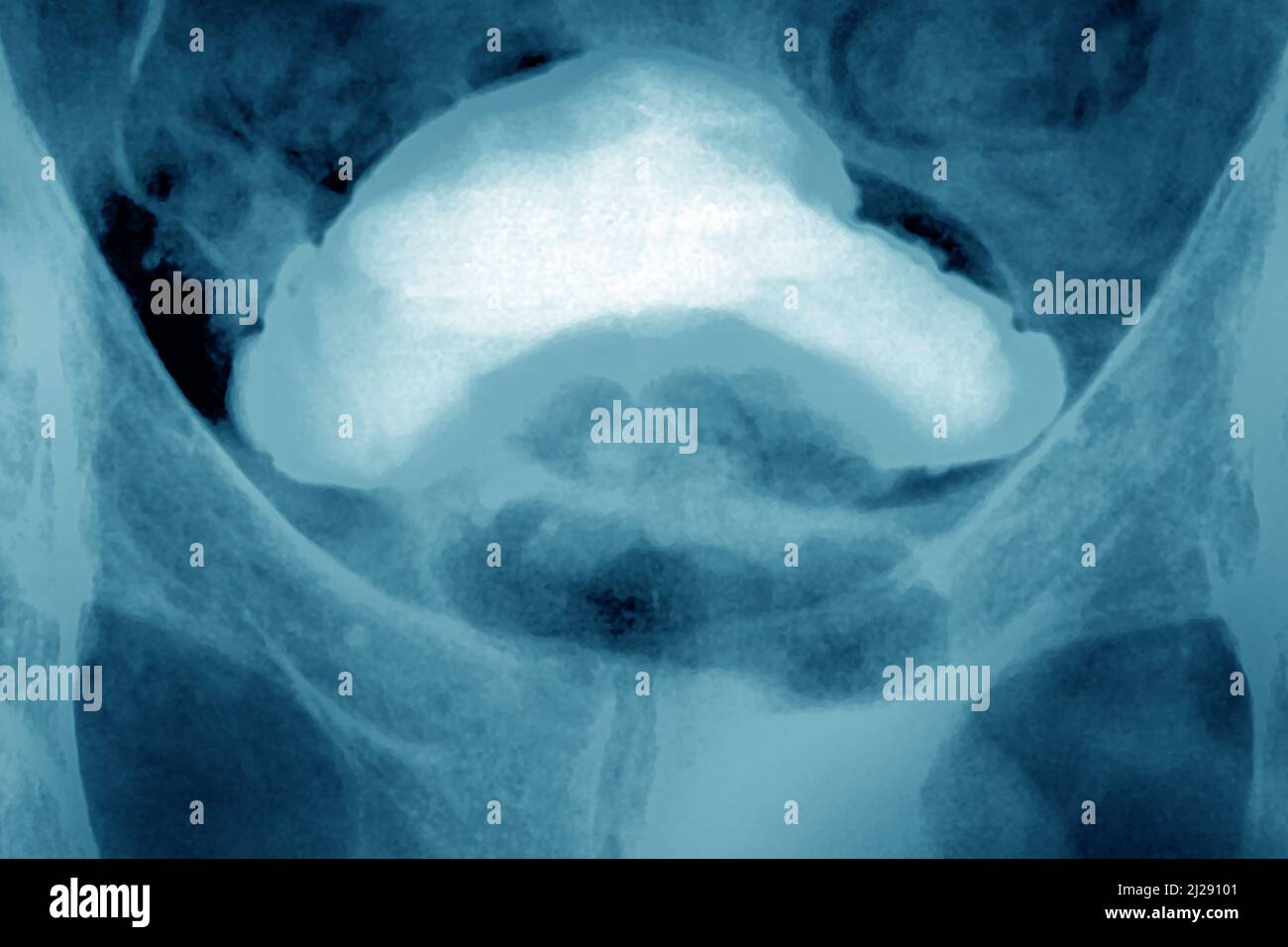 Carcinoma della prostata Foto Stock