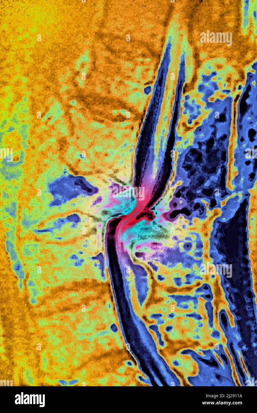 Traumatismo di dislocazione Foto Stock