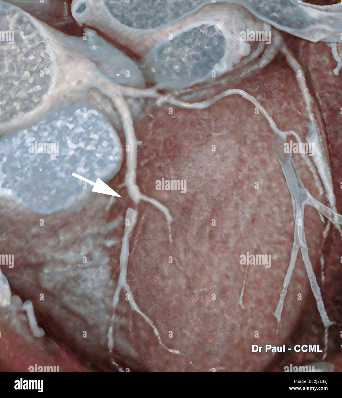 Stenosi coronarica, scansione 3D Foto Stock