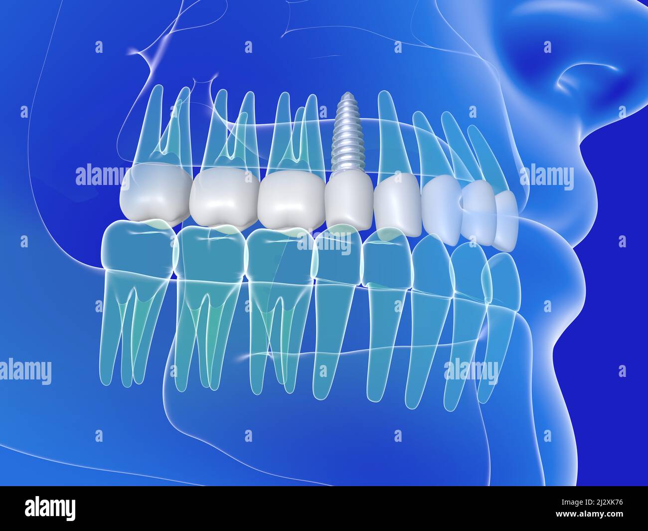3d illustrazione di un impianto dentale. Immagine anatomica dei denti e della bocca, trasparente su sfondo blu. Foto Stock