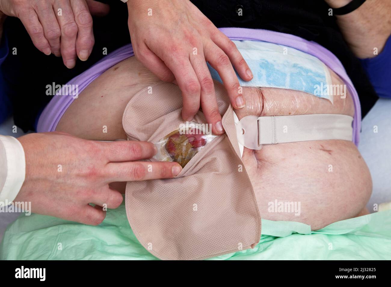 Olanda, Una colostomia è un'apertura (stoma) nell'intestino crasso (colon), o la procedura chirurgica che ne crea uno. L'apertura è formata da dr Foto Stock