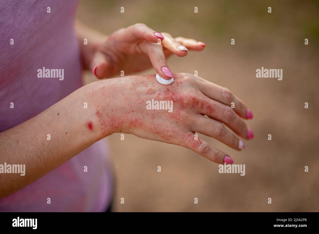 Trattamento dell'eczema immagini e fotografie stock ad alta risoluzione -  Alamy