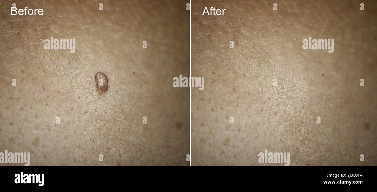 Foto prima e dopo la rimozione del Papilloma grande sulla pelle della donna. Concetto di rimozione del papilloma. Messa a fuoco selettiva Foto Stock
