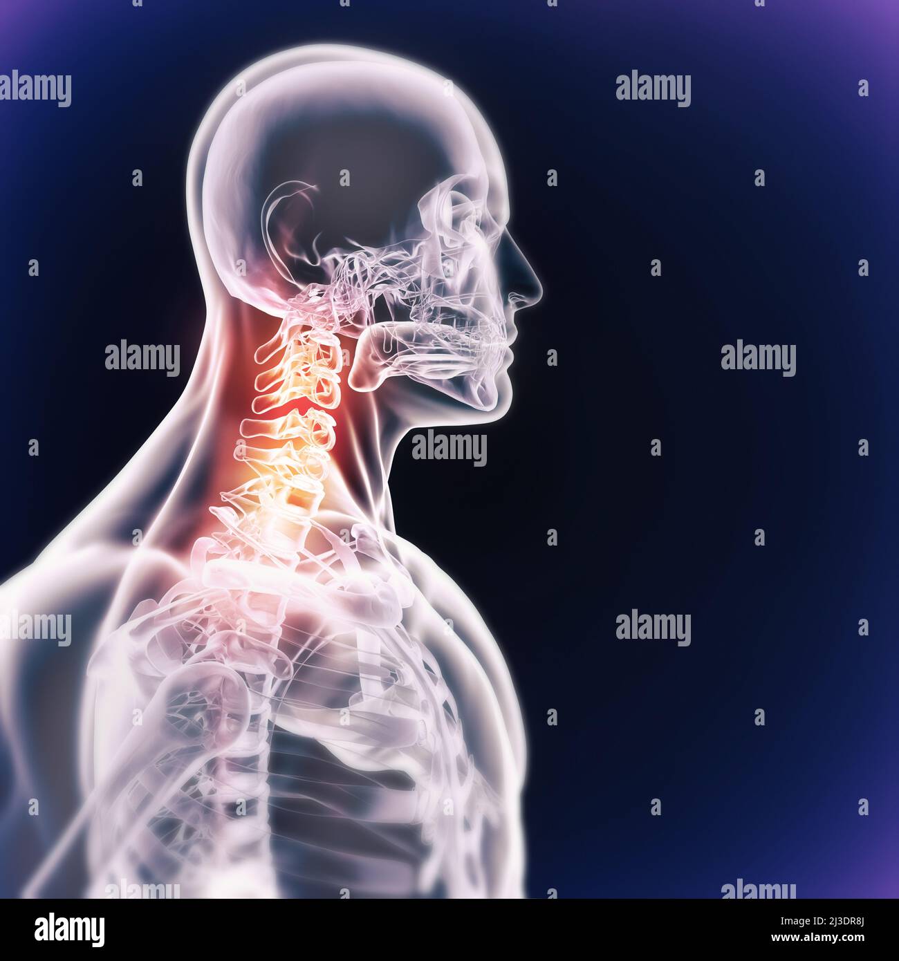 Quando colpisce l'infiammazione. Una vista cgi di un'articolazione infiammata isolata su blu. Foto Stock