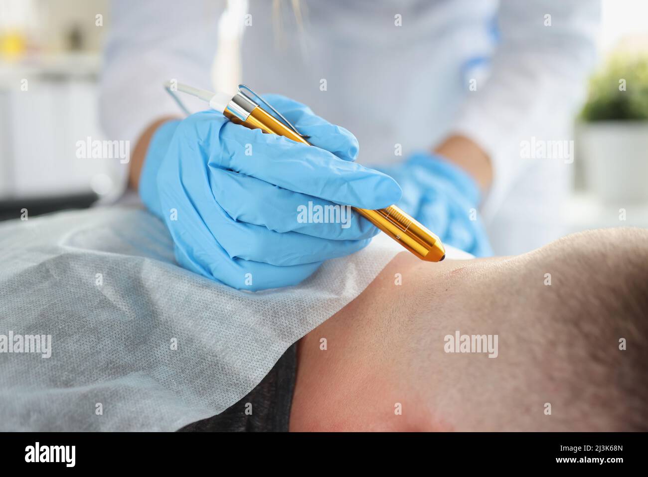 Il dermatologo rimuove le formazioni sul collo dell'uomo con il laser Foto Stock