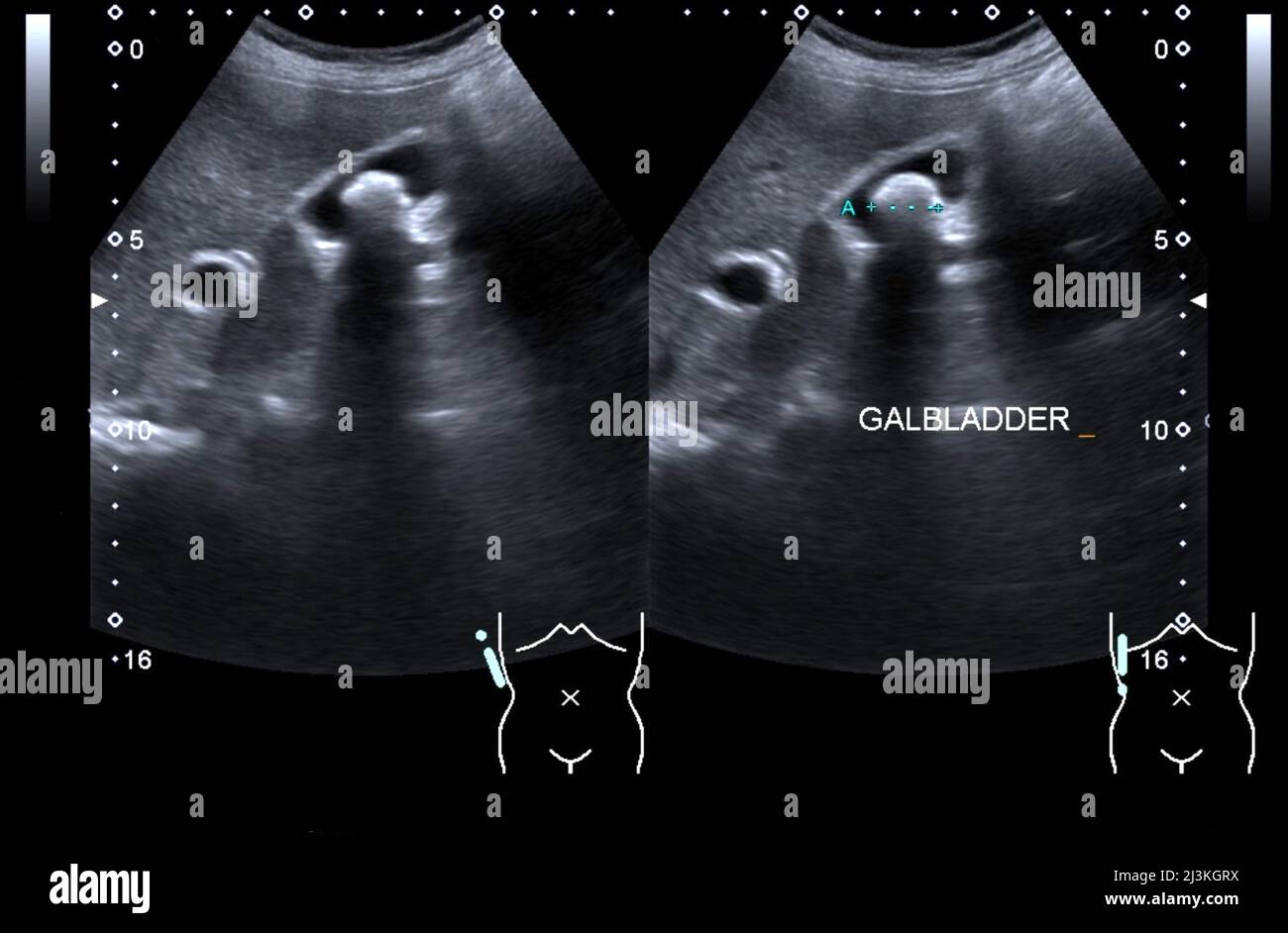 Calcoli biliari, scansione ecografica Foto Stock