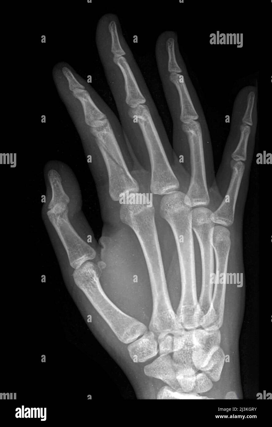 Seconda frattura falanice della mano, raggi X. Foto Stock
