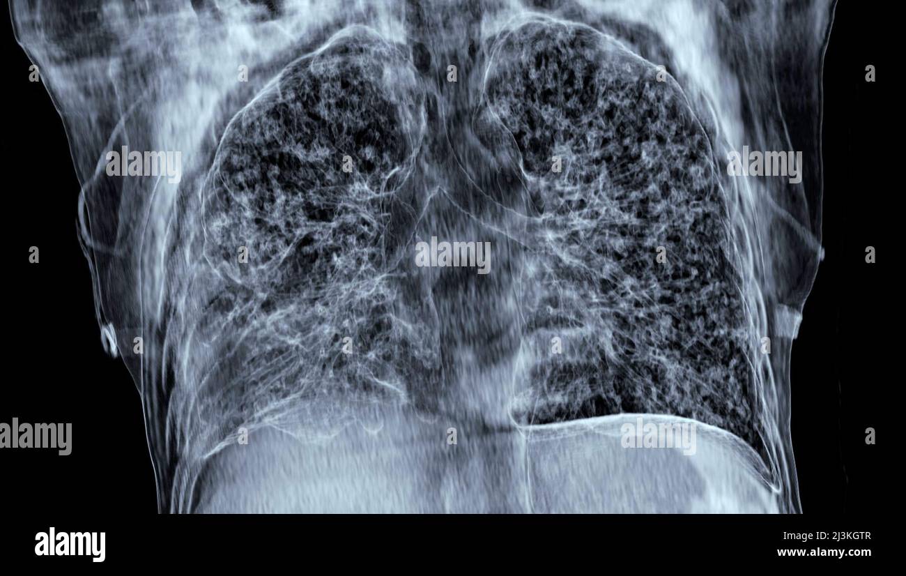 Tubercolosi miliare, scansione 3D CT Foto Stock