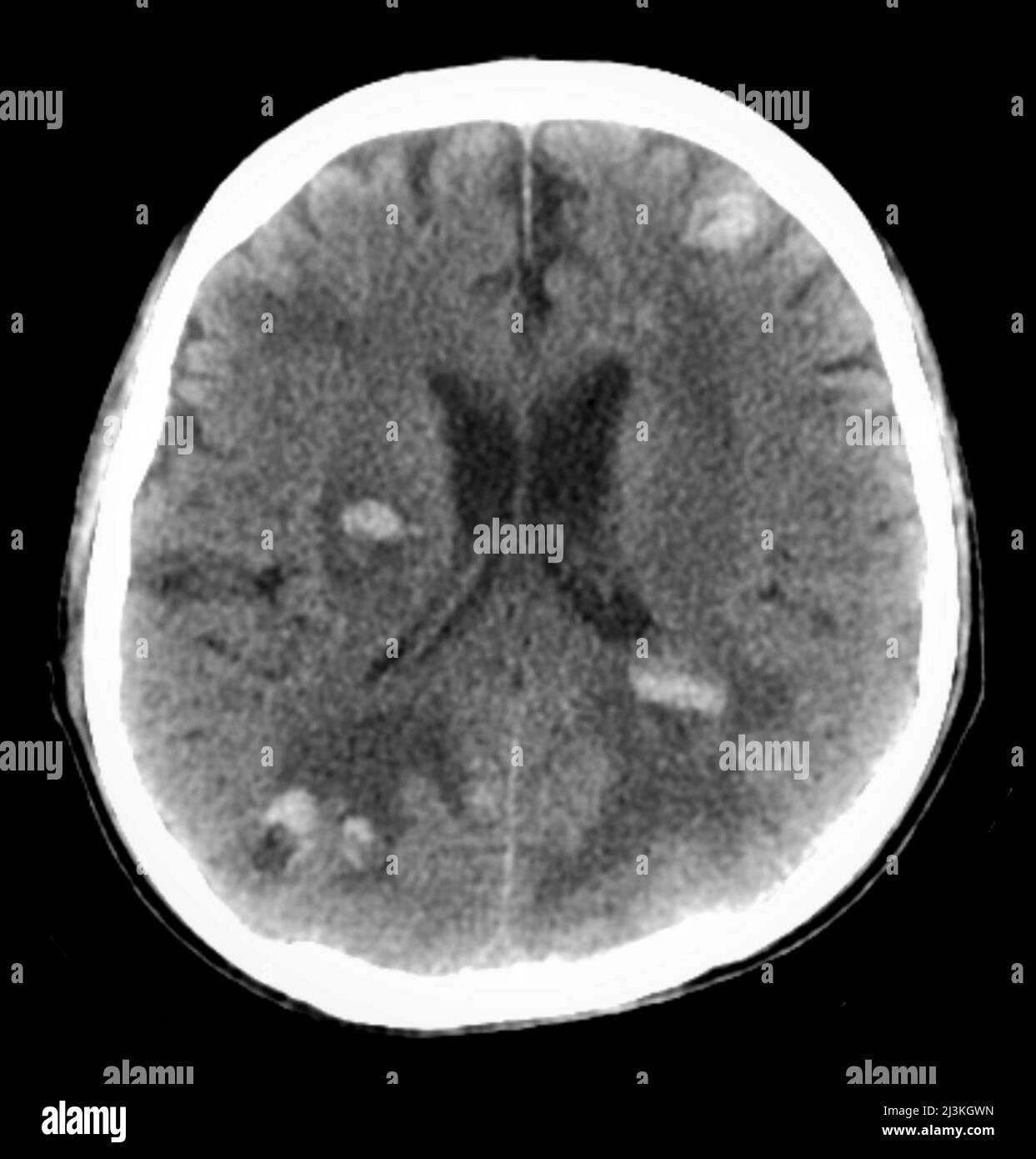 Metastasi cerebrali emorragiche, scansione TC Foto Stock