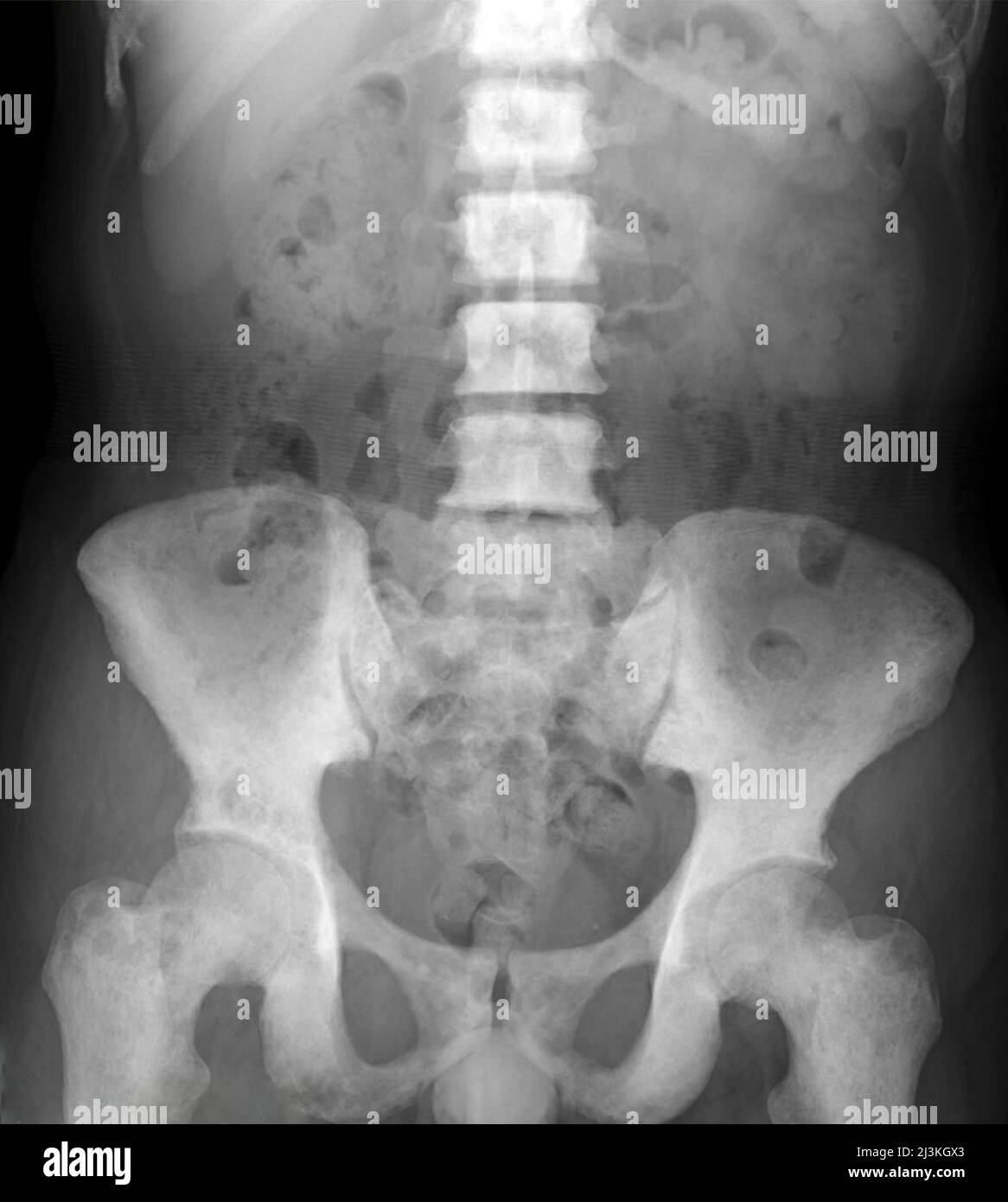 Metastasi ossee del bacino, raggi X. Foto Stock