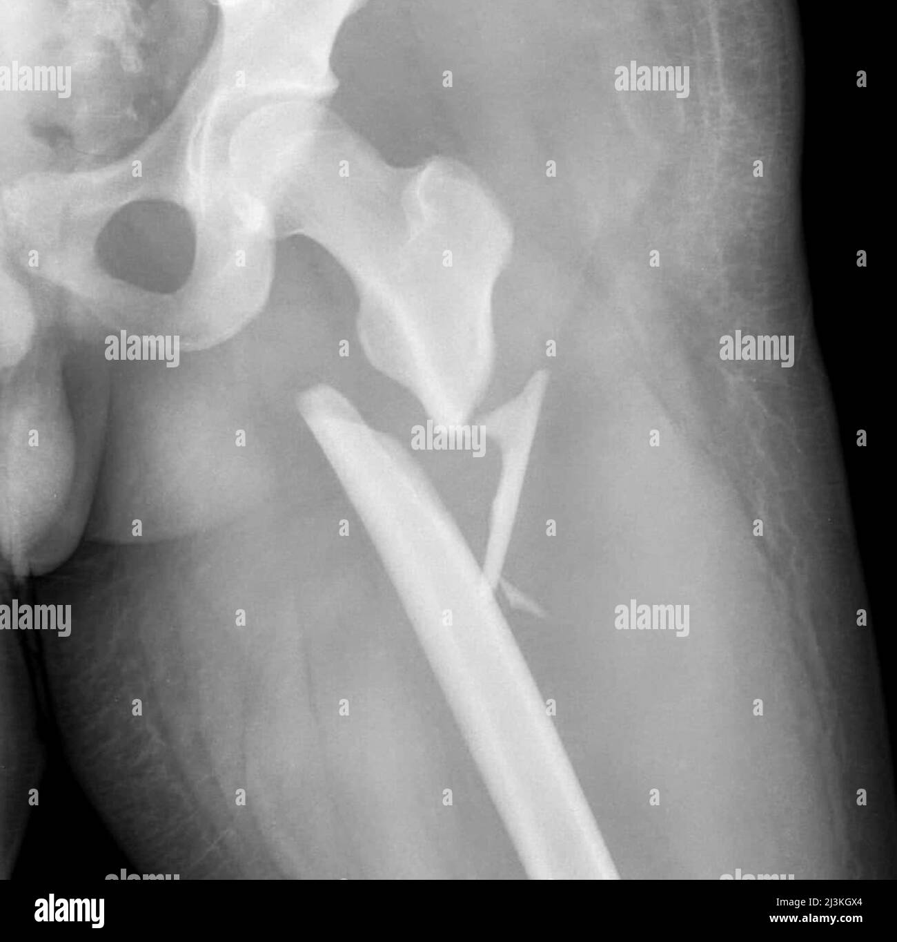 Frattura femorale comunitativa, raggi X. Foto Stock