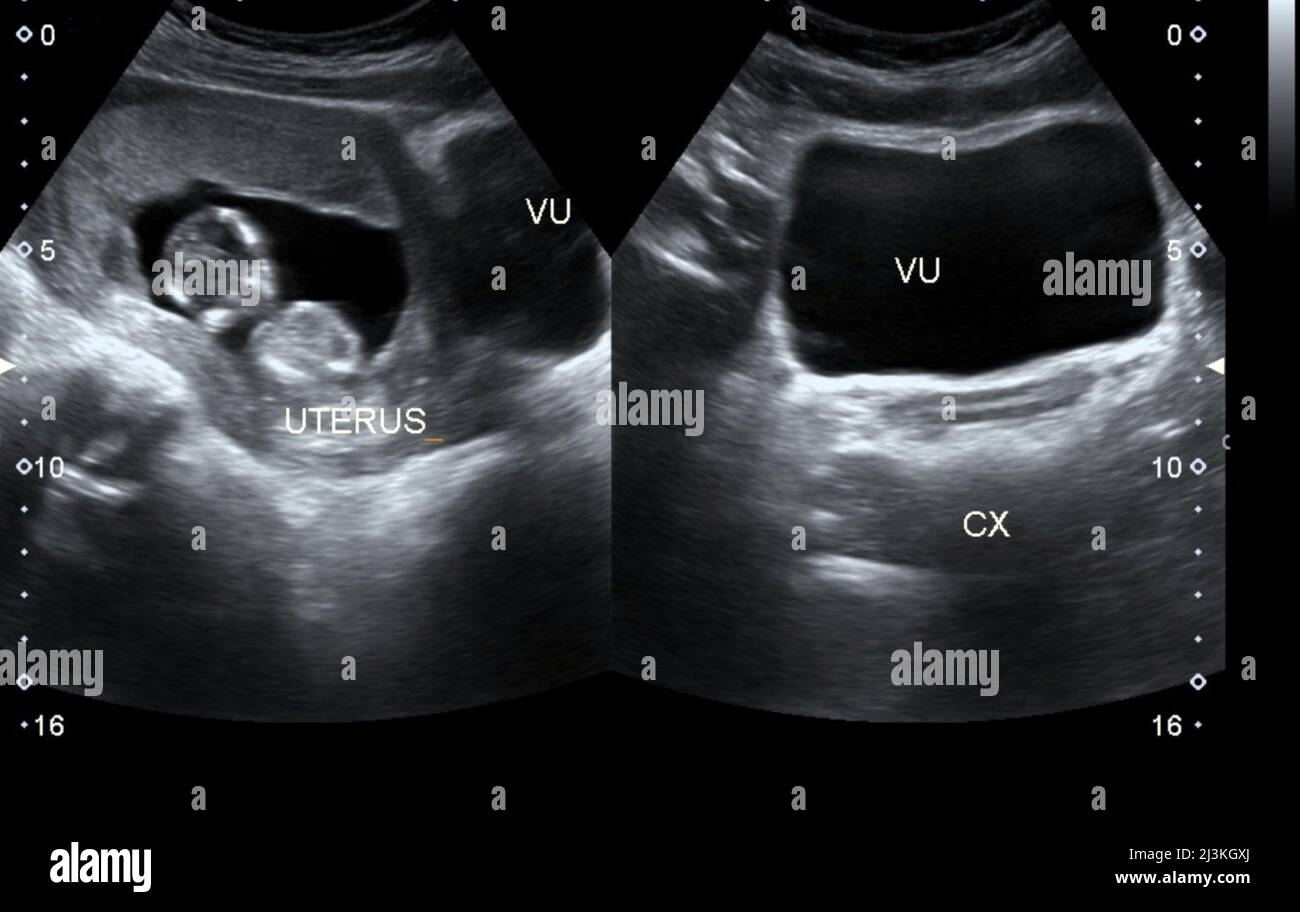 feto di 16 settimane, scansione a ultrasuoni Foto Stock