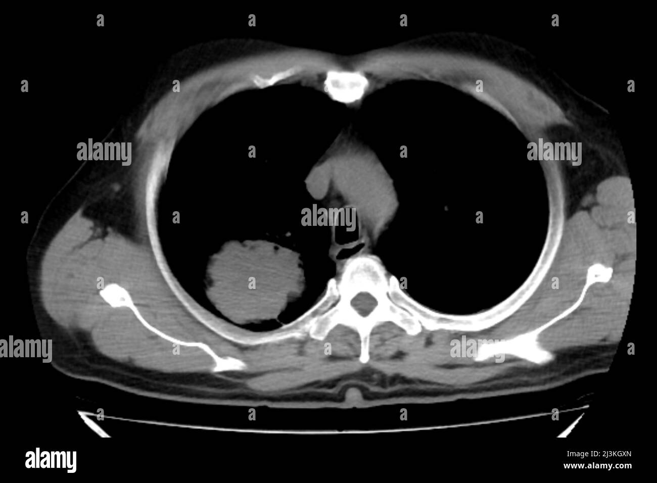 Carcinoma polmonare, scansione TC toracica Foto Stock