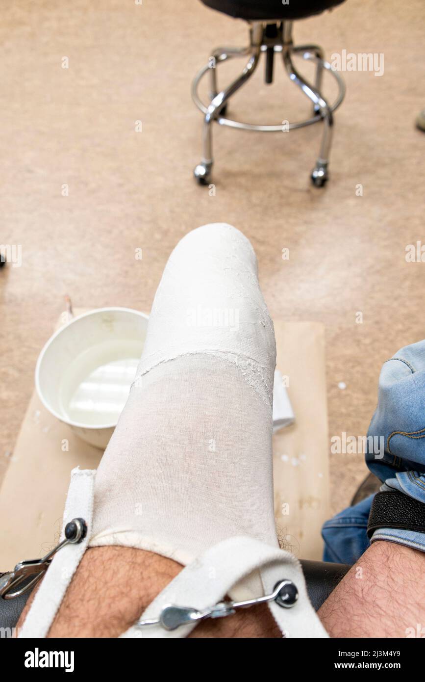 Primo piano di una gamba amputata avvolta in un cerotto in gesso per un montaggio di protesi; Edmonton, Alberta, Canada Foto Stock
