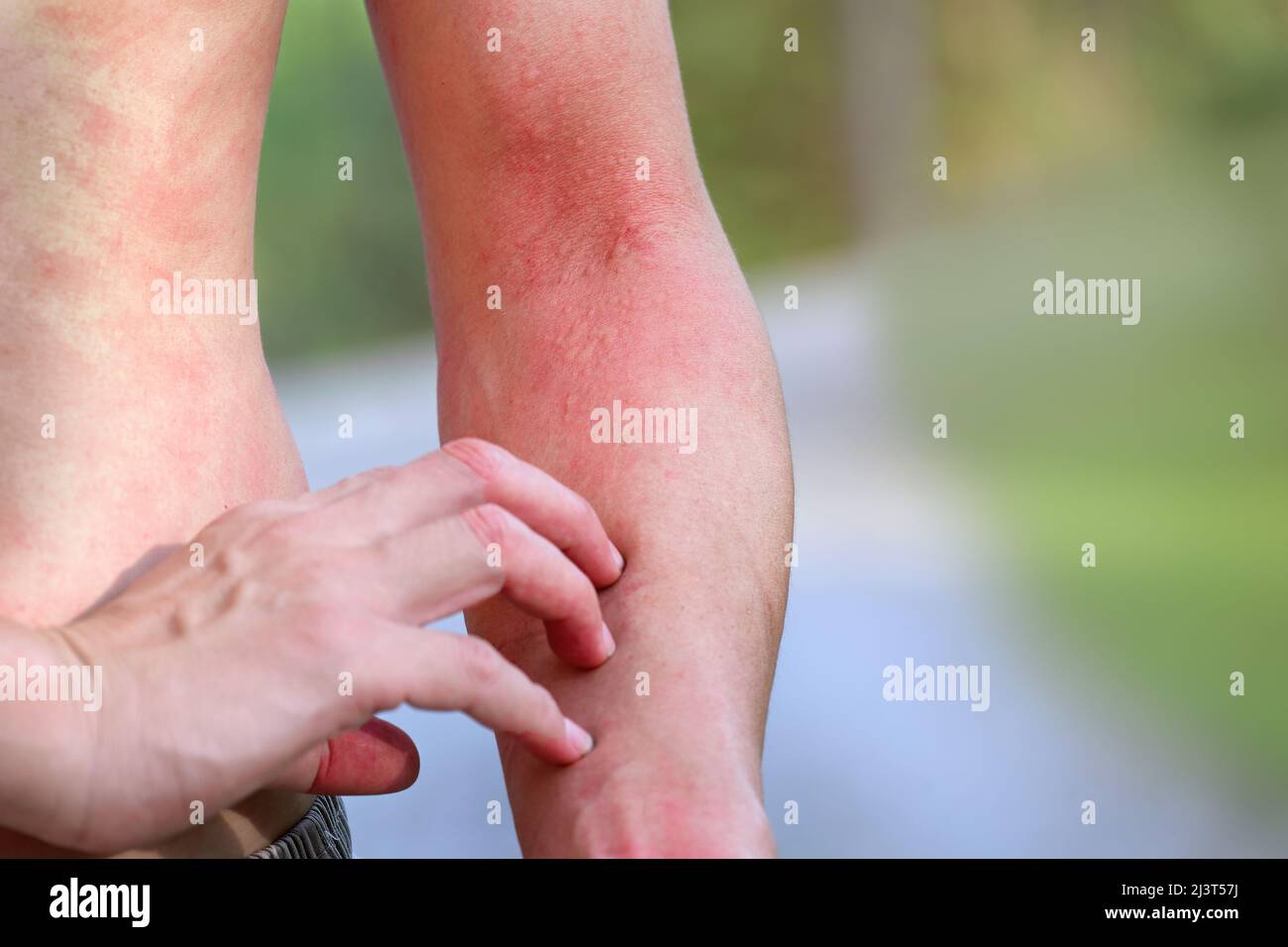 uomo che soffre di prurito sul corpo della pelle del braccio e graffiare un posto prurito. Reazione allergica all'allergia di un pungiglione o punture di insetti del caterpillar Foto Stock