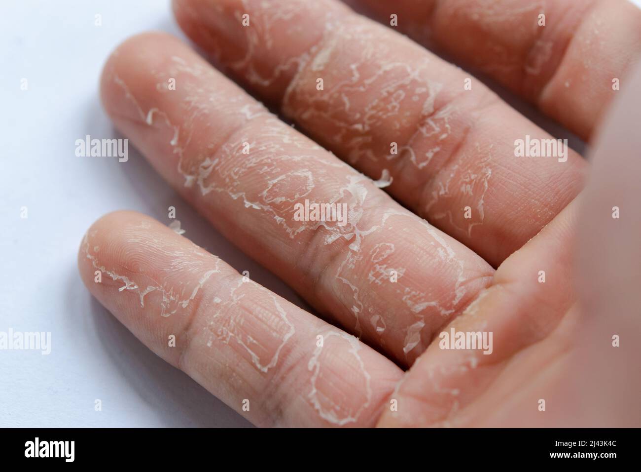 Pelare la pelle sulle mani e sulle dita. Desquamazione Foto stock - Alamy