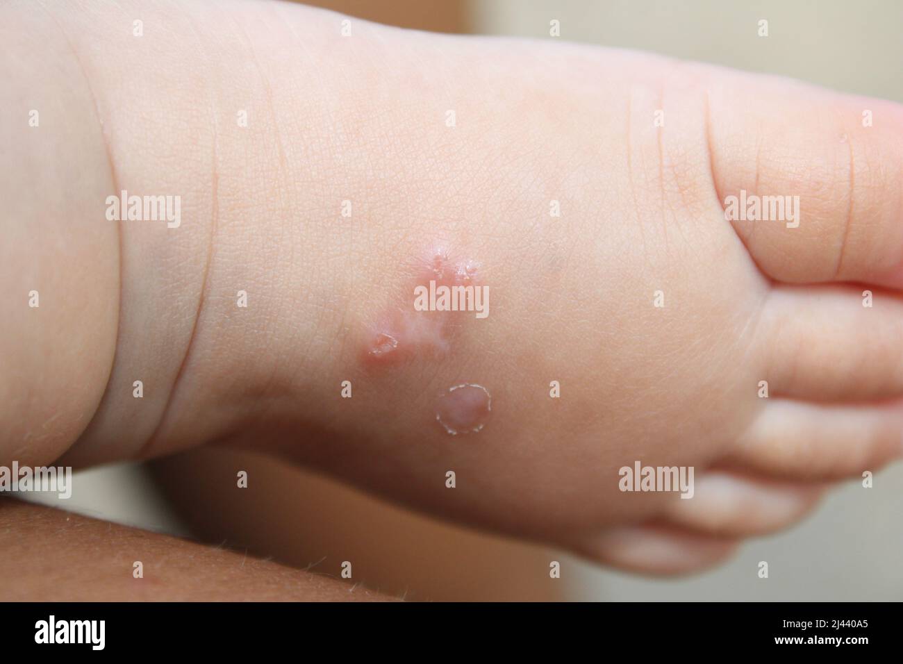 Primo piano del piede di un bambino con infezione da scabbia (sarcoptica mange), catturato a Port Moresby, Papua nuova Guinea, 2022. Ideale per applicazioni mediche, dermatologiche, Foto Stock