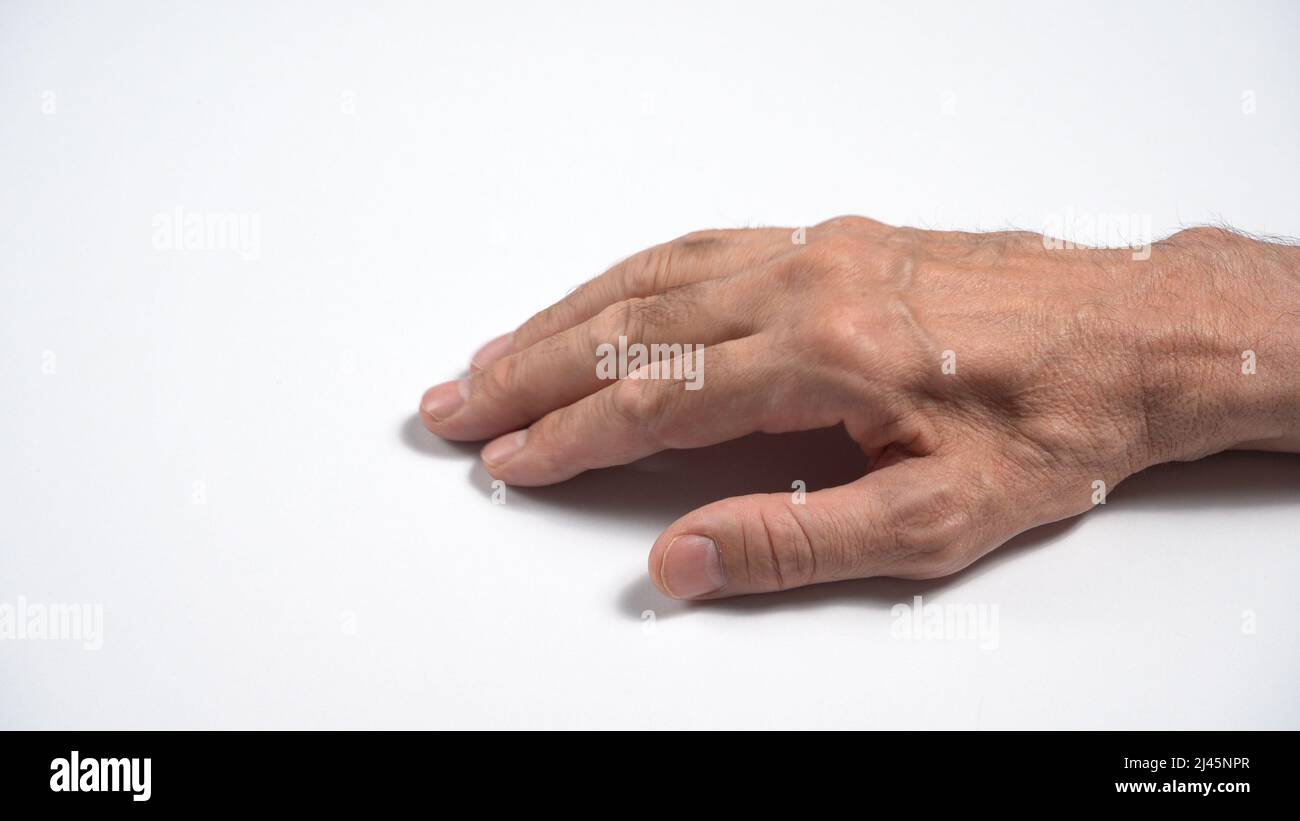 Mutazioni nella polineuropatia sensorimotoria assonale adulta. Foto Stock