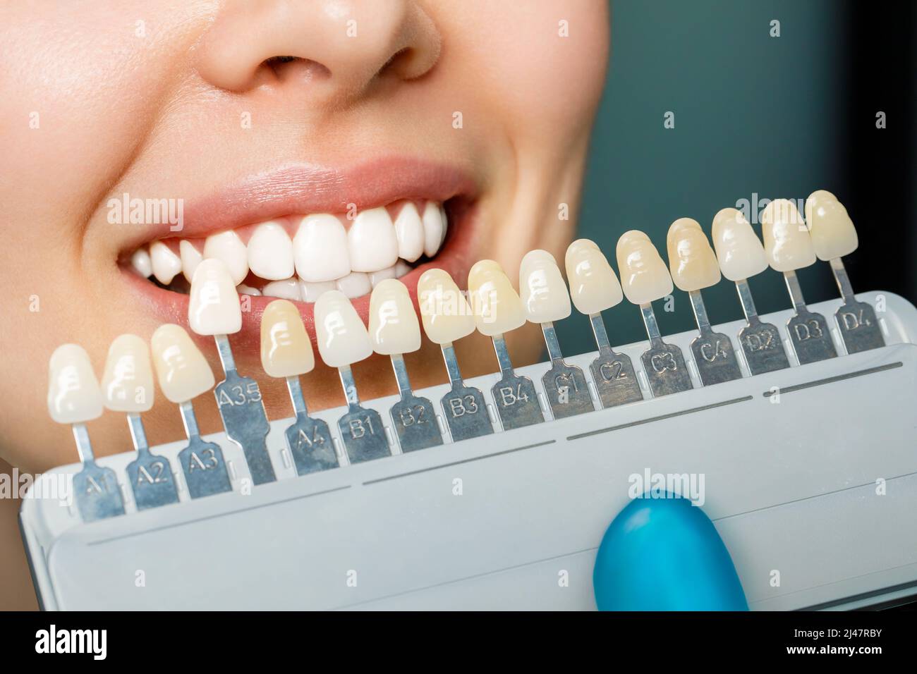 Giovane donna sorridente. Denti cosmetologici sbiancanti in una clinica odontoiatrica selezione del tono del dente dell'impianto Foto Stock