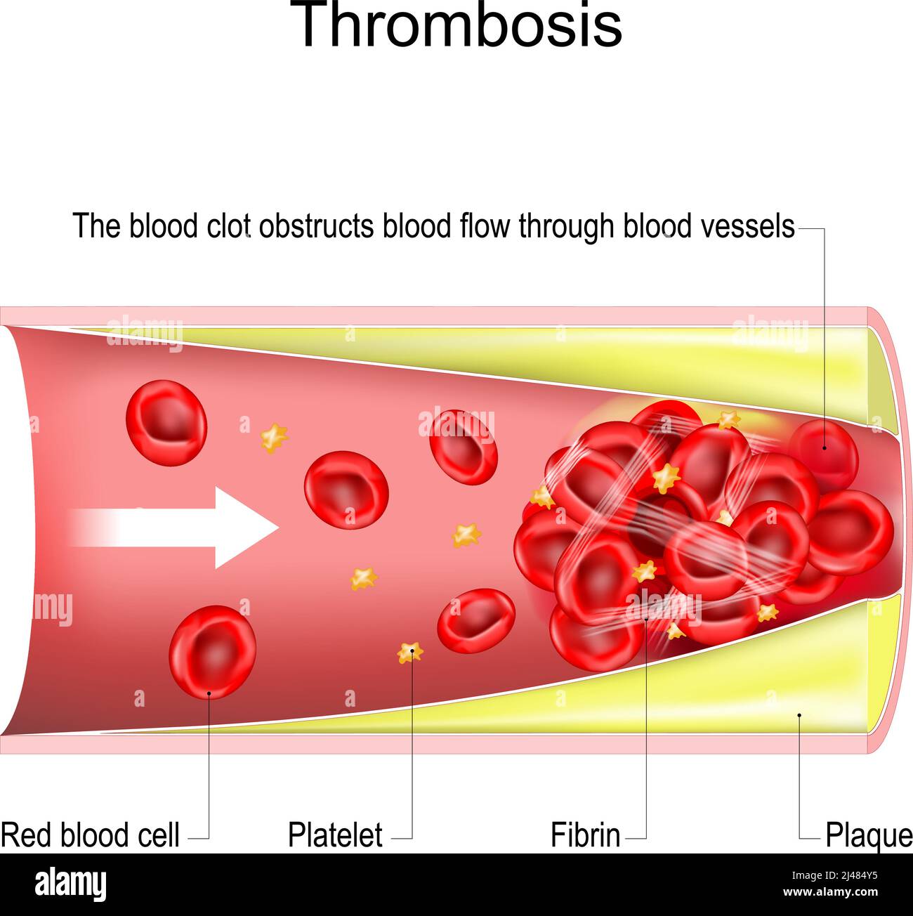 trombosi. Il coagulo di sangue ostruisce il flusso di sangue attraverso i vasi sanguigni. Sezione trasversale del vaso sanguigno con placca aterosclerotica, globuli rossi, Pla Illustrazione Vettoriale