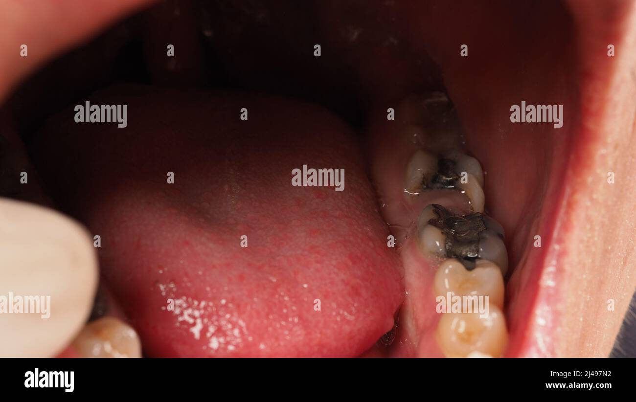 Trattamento del canale della radice del dente decaduto. Carie dentali o dentali di molari inferiori. Restauro con riempimento composito. Carie adulte. Denti cattivi. Tempora dentale Foto Stock