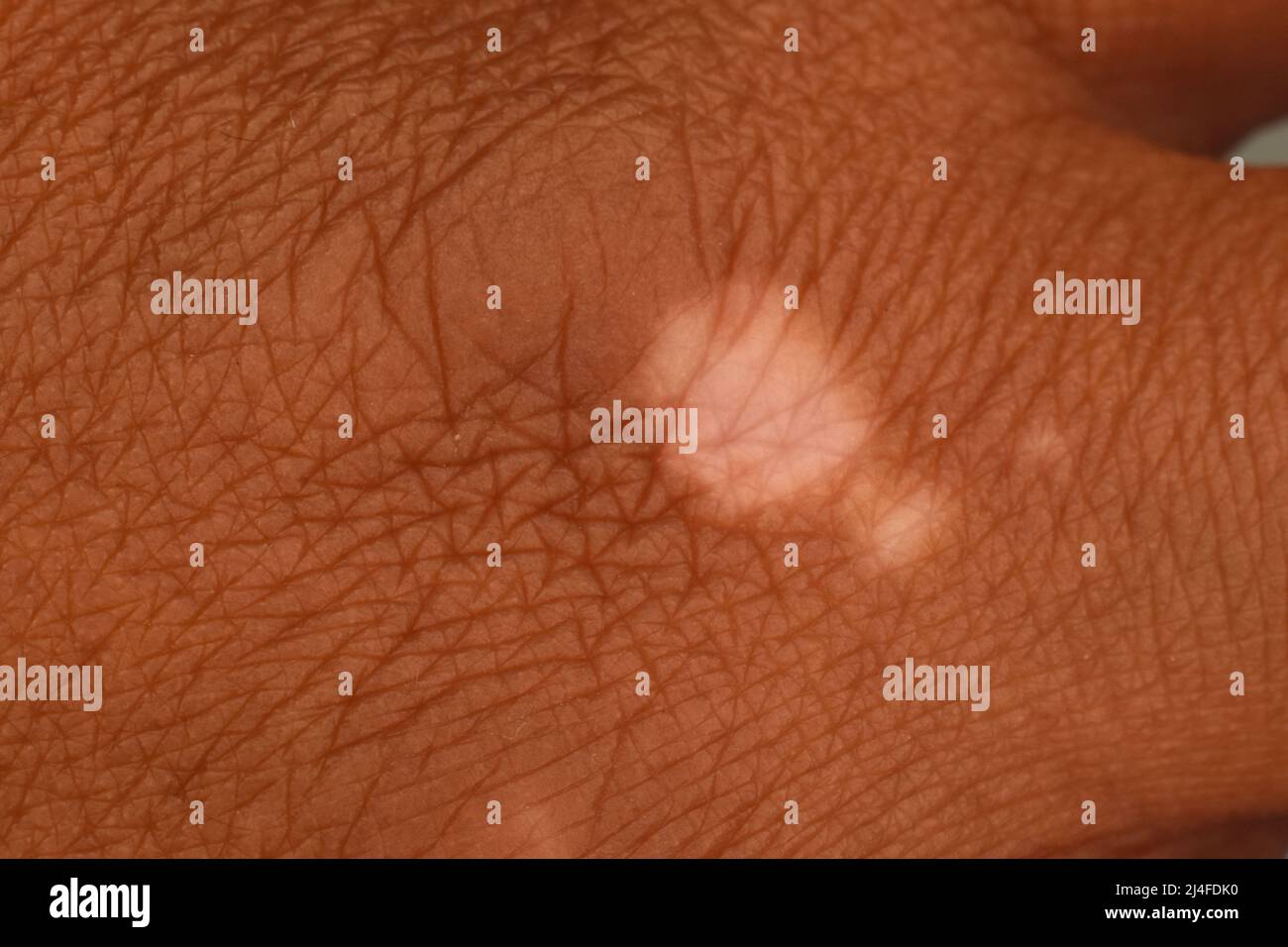 Vitiligo è una condizione in cui la pelle perde le sue cellule di pigmento (melanociti). Vitiligo si verifica quando le cellule che producono pigmenti muoiono o interrompono il funzionamento. Foto Stock