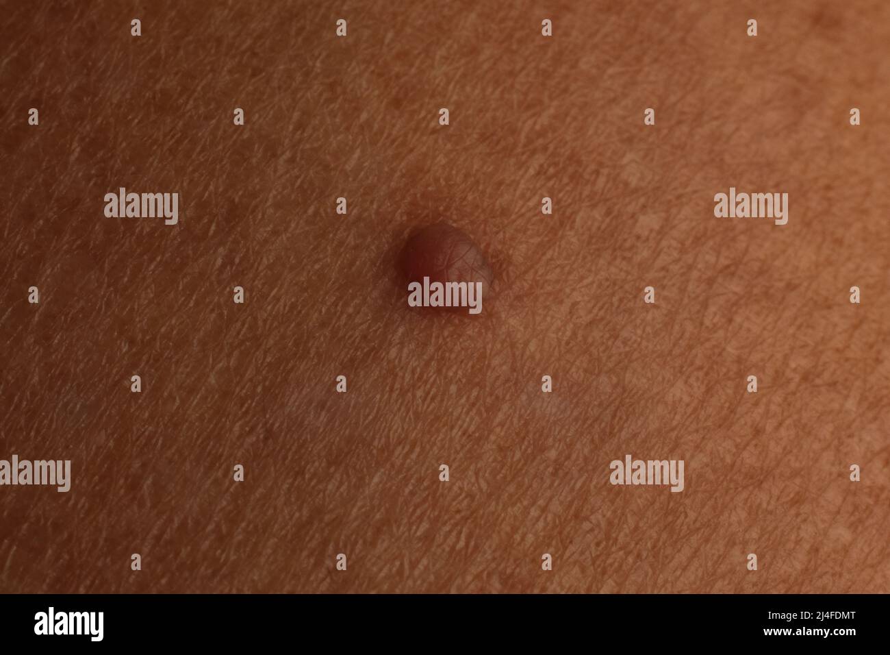 Un grumo cresce sulla pelle dell'uomo di mezza età. Foto Stock