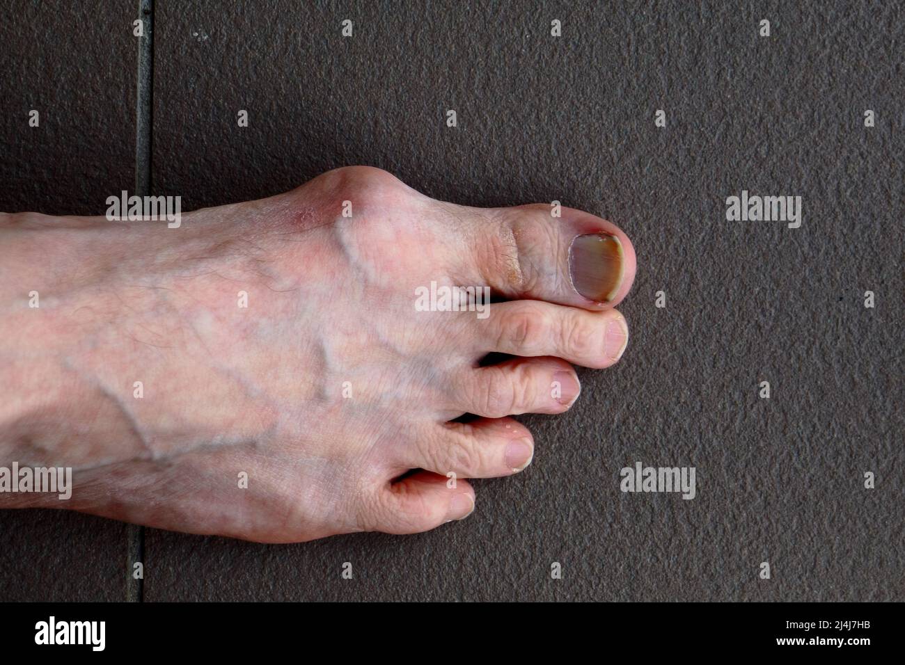 Grande raccordo sul piede destro maschio Foto Stock