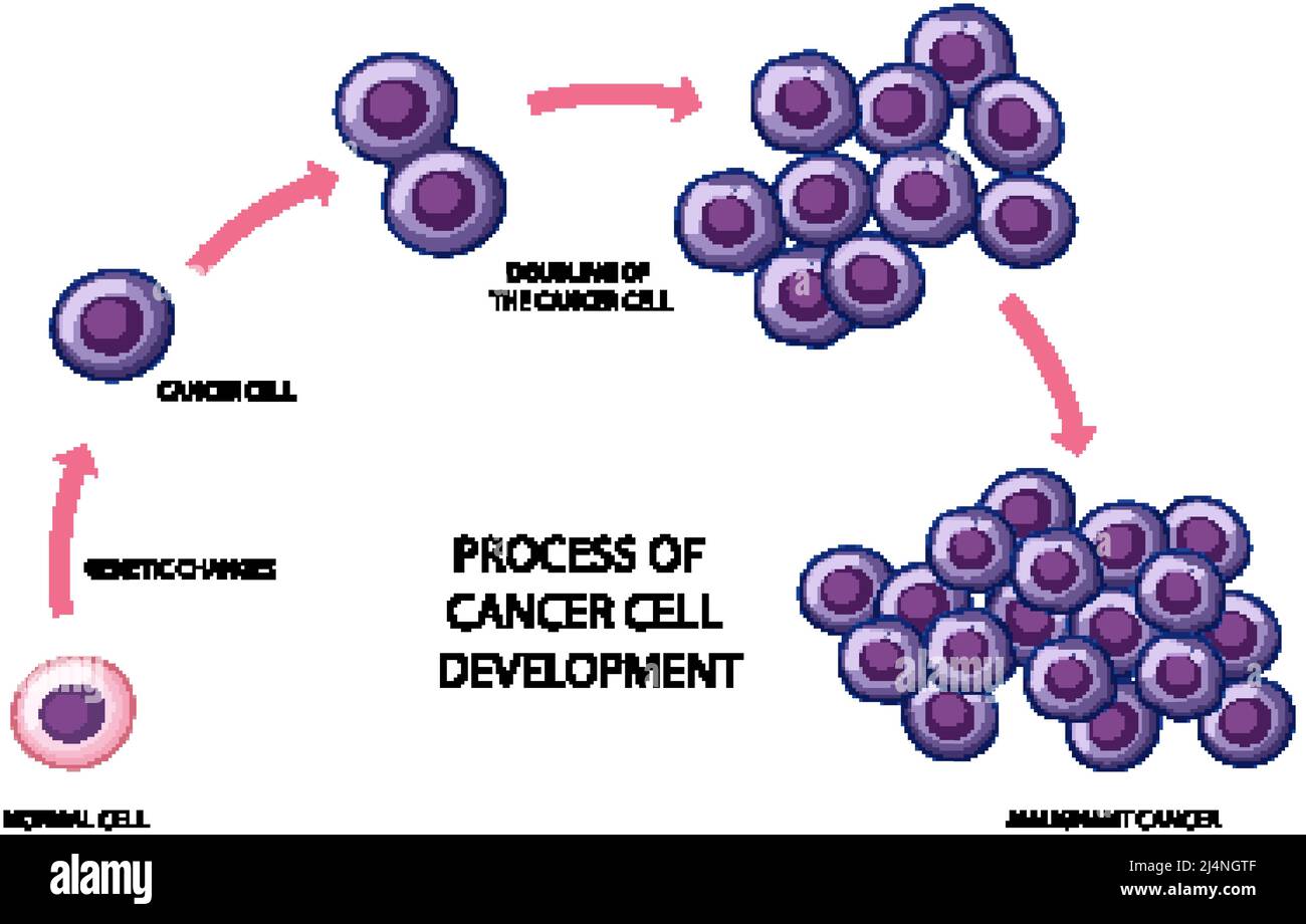 Processo di illustrazione dello sviluppo delle cellule tumorali Illustrazione Vettoriale