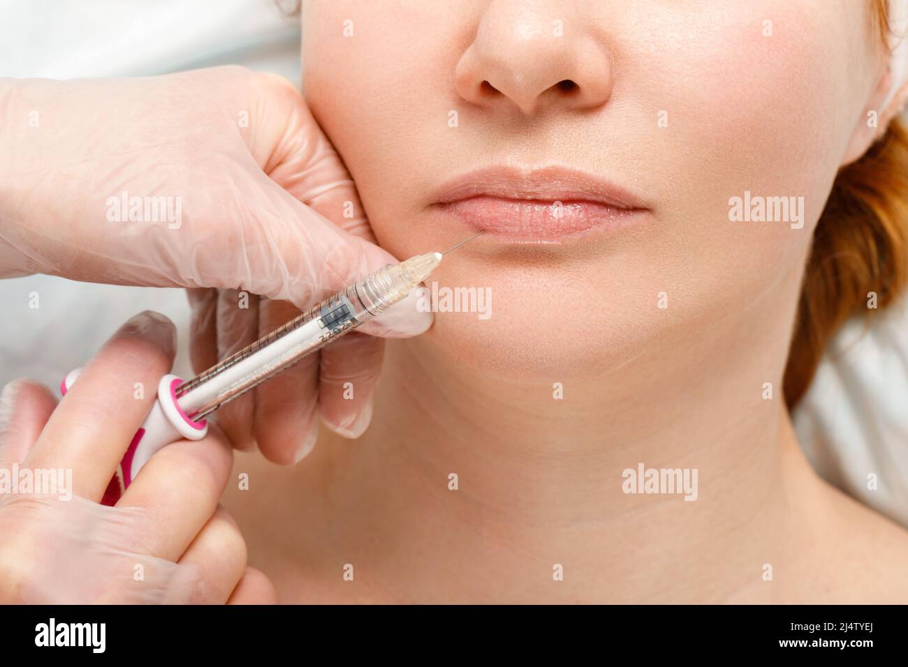 Una donna fa la correzione della forma del labbro in una clinica di cosmetologia. Iniezioni delle labbra, aumento delle labbra. Foto Stock