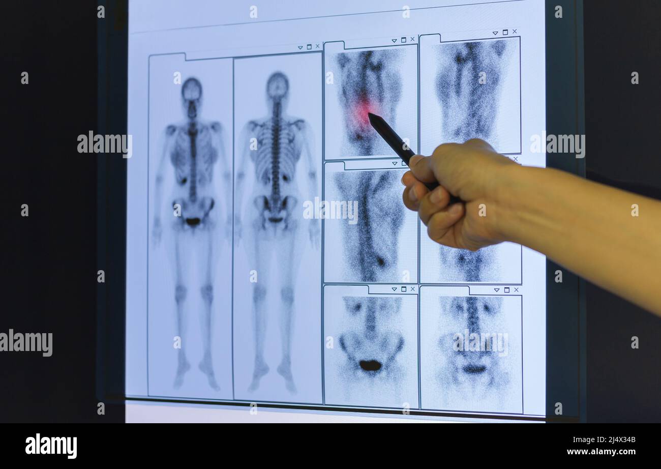 Mano del medico che punta sulla pellicola radiogena dello scheletro. Foto Stock