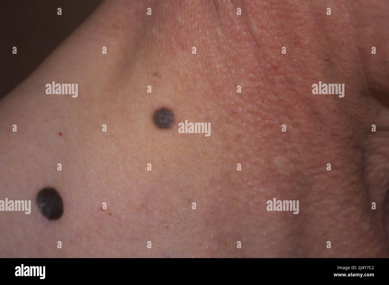 Cambiamento della pelle, screening del cancro, primo piano dei segni di nascita sul collo e sulla spalla Foto Stock