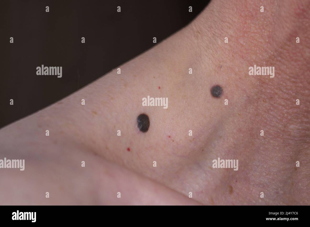 Cambiamento della pelle, screening del cancro, primo piano dei segni di nascita sul collo e sulla spalla Foto Stock